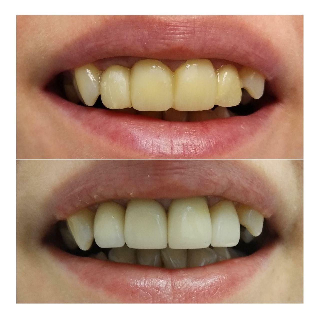 Приклади робіт стоматології у Вишгороді Natalie dental clinic
