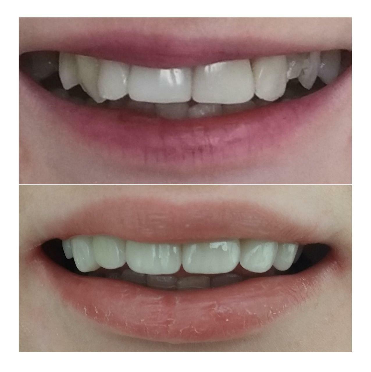 Приклади робіт стоматології у Вишгороді Natalie dental clinic