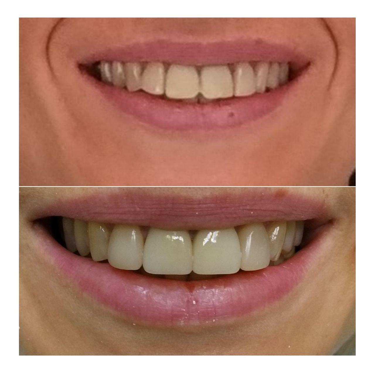 Приклади робіт стоматології у Вишгороді Natalie dental clinic