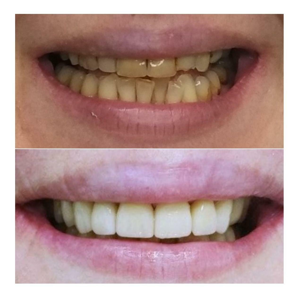 Приклади робіт стоматології у Вишгороді Natalie dental clinic